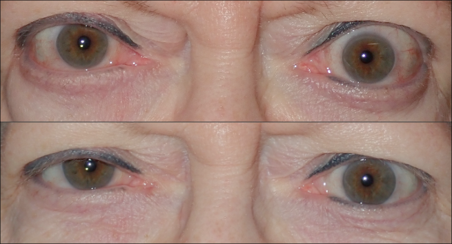 Thyroid Eye Disease photos showing a patient who has had TED for years at baseline and at Week 24 following TEPEZZA treatment, frontal view.