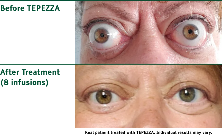 Photos of patient with Chronic Thyroid Eye Disease before and after TEPEZZA treatment, with post-treatment photo showing reduced eye bulging after 8 infusions