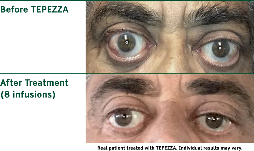 Comparison photos of patient with Thyroid Eye Disease before and after TEPEZZA treatment, with post-treatment photo showing reduced eye bulging after 8 infusions